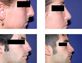 Rinoplastia - cirugia de la nariz en Madrid- Dr. Federico Mayo