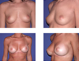 antes y después de aumento de senos