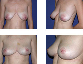 Mastopexia (elevación de las mamas) 1