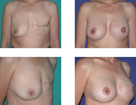 Reconstrucción mamaria postmastectomía 1