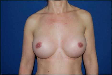 Aumento mamario con implantes redondos