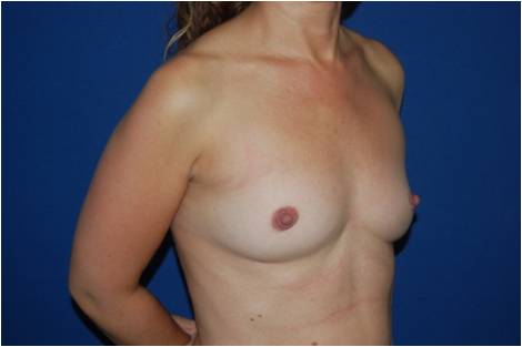 Aumento mamario con implantes redondos