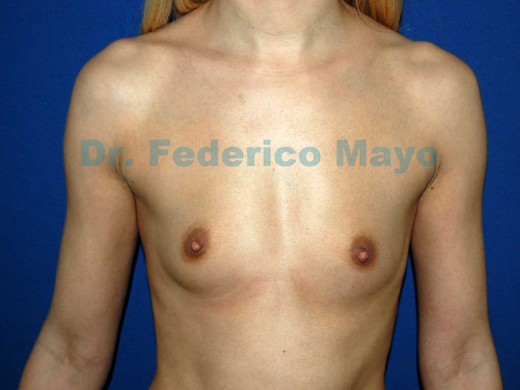 Aumento mamario con implantes anatómicos True Fixation